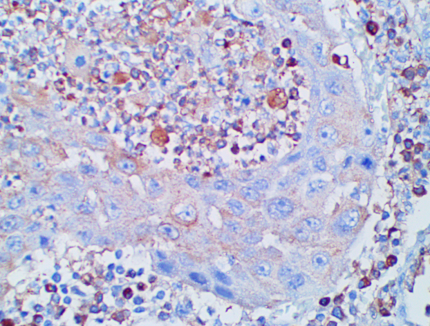 Inmunohistoquímica usos en el diagnóstico de procesos tumorales