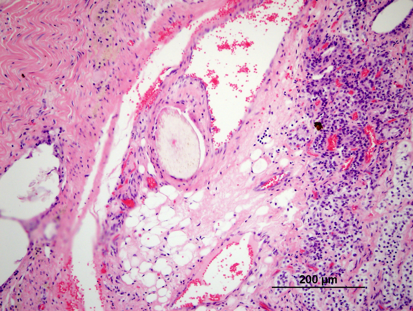 Teratoma Ovárico: Un raro tumor de origen embrionario